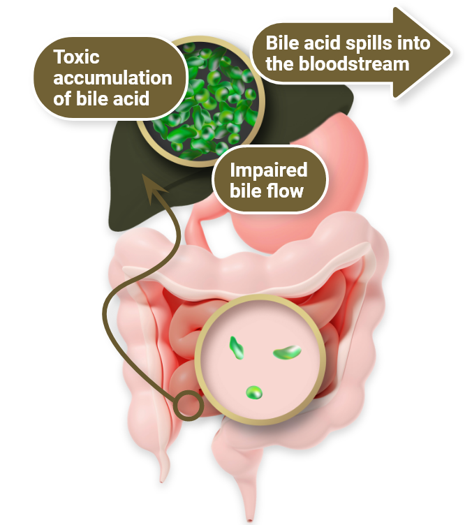 Arrows show the way bile acids spill into the bloodstream, impairing the flow, and building up in toxic amounts in a liver with ChLD  (134)