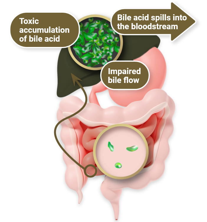 Arrows show the way bile acids spill into the bloodstream, impairing the flow, and building up in toxic amounts in a liver with ChLD