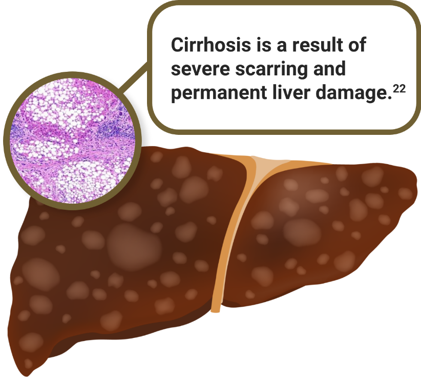 Cirrhosis is a result of severe scarring and permanent liver damage