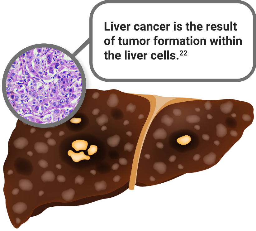 Liver cancer is the result of tumor formation within the liver cells