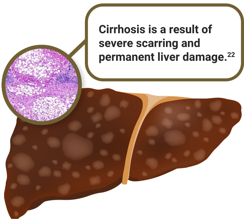 Cirrhosis is a result of severe scarring and permanent liver damage