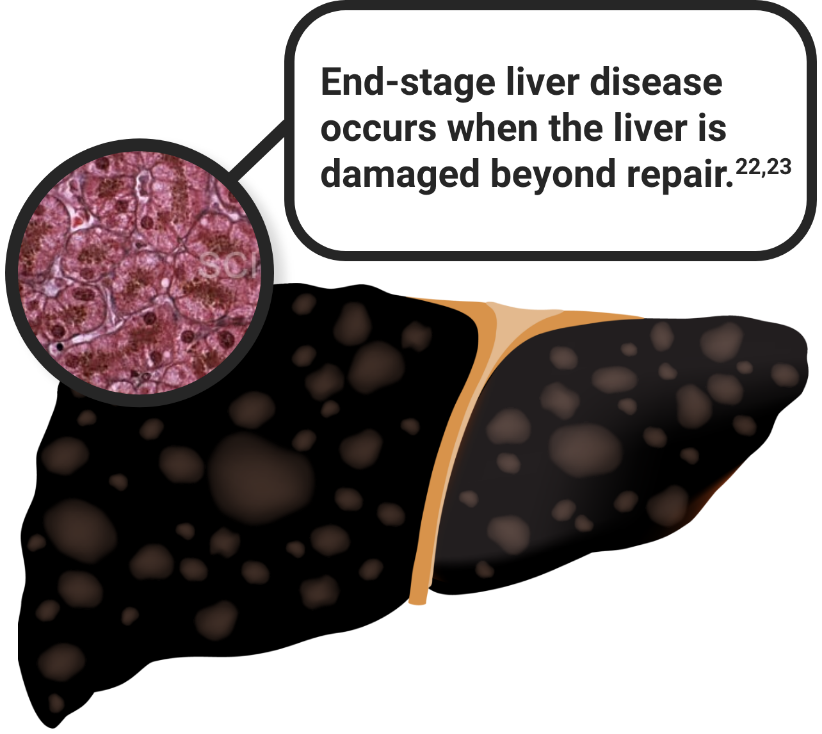 End-stage liver disease occurs when the liver is damaged beyond repair